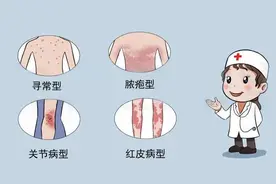 潍坊市人民医院专家跟您谈谈银屑病关节炎图片