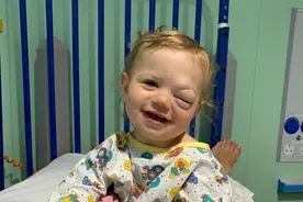 2岁女婴眼睛里长淋巴管瘤 一哭就流血泪图片