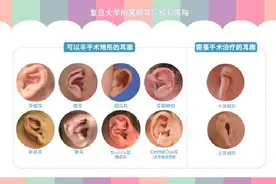招风耳、精灵耳、杯状耳……先天性耳廓畸形可非手术矫正，有多少家长错过了？图片