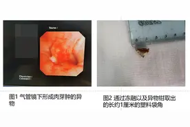 男子咳嗽年余不止，起因是5年前撕咬塑料包装吸入一角图片