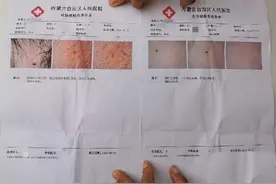 呼和浩特“多名幼儿身上现针眼案”：3涉案教师被捕图片