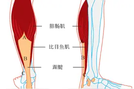 训练营｜患上跟腱炎，还能跑步吗？图片