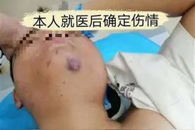 男子要求更换过期商品被打断12根骨头，施暴人曾威胁其签署谅解书图片