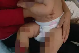 揪心！1岁7个月幼童在家打翻火炉，被煮沸的鸡汤严重烫伤图片