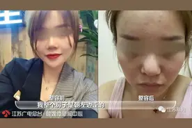 整形后鼻子歪了！医院一句话惊呆女子：我们多存了你的肋骨，可修复图片