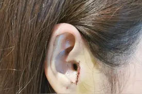 如此整形！取耳软骨做鼻头整形，鼻子好看了耳朵有个缺口 当事人：耳机都挂不住图片