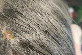 24岁女子漂染后头皮流脓 理发店说“正常，过几天就好了”？图片