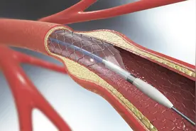 1.3万元降至700元左右，心脏支架你还敢用吗？图片