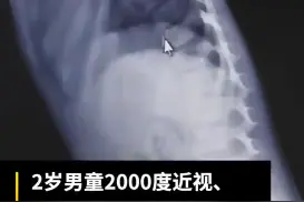 2岁男童近视两千多度确诊马凡综合征，医生：患病率低于万分之一图片