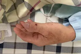 男子高烧40℃险丧命，竟是猪肉惹的祸图片