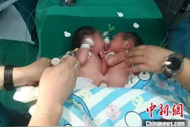 新疆首例连体婴儿分离手术成功完成图片
