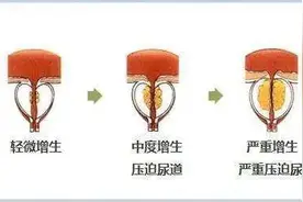 80岁老人前列腺增生排尿困难10年，这个微创手术可帮了大忙图片