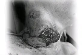 七旬阿婆颈部肿块疯长9年，中山七院专家精准“拆弹”图片