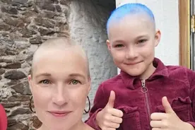 英国9岁女孩因疫情封锁压力骤增 导致头发掉光图片