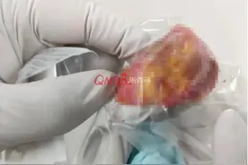 34岁女子腿上长了个肿块近3年，没想到里面有近10条寄生虫图片