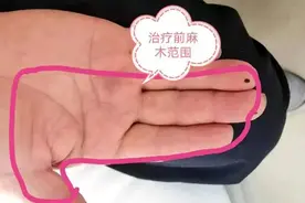 长期手指麻木、肿胀的王大爷：早知道，早点过来治疗图片