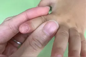 【儿研所儿医说】孩子的指甲怎么这样了呢？图片