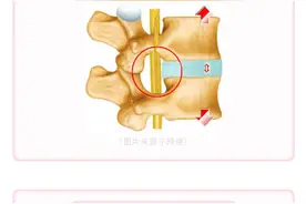 睡硬板床硌得浑身痛，却能改善腰椎间盘突出？图片