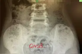 家长要警惕！因好奇，6岁男孩往肛门塞了3.9厘米的铁丝图片