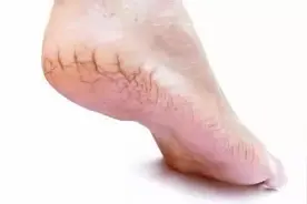 为什么有些人脚后跟经常开裂？可能与这几个原因有关，尽量别忽视图片