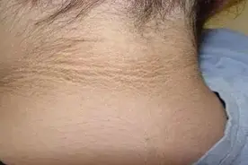 脖子上出现这个东西，是糖尿病的表现！赶快重视起来图片