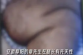 男子左腿长102斤肿瘤：共花25个小时切除，缝了600针图片