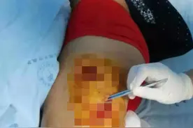 四川米易县一村民被黑熊咬伤 当地村民：4年多至少3人遭熊袭击受伤图片