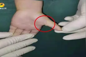 家长注意！手机玩太久，三岁女孩手指成“扳机指”图片