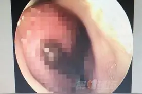 还会动！女子鼻腔取出6厘米水蛭，只因她做了这件事图片