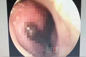 还会动！女子鼻腔取出6厘米水蛭，只因她做了这件事图片