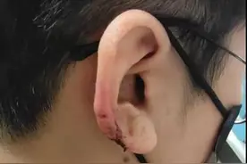女子去理发，结果耳朵被剪掉一块图片