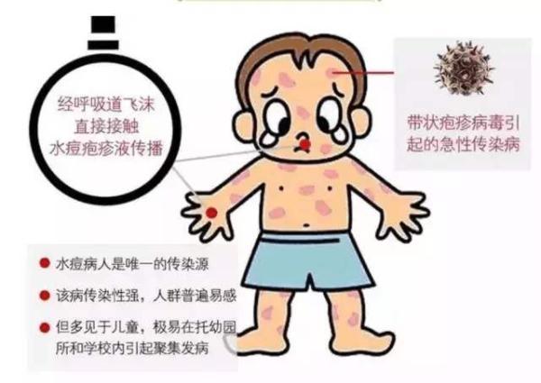 水痘的症状,主要是哪些？（认识水痘）