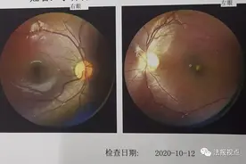 照射几秒钟，9岁孩子左眼失明图片