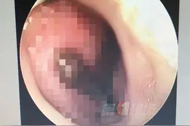 后怕！女子鼻腔取出6厘米活蚂蟥 只因用了这种水图片