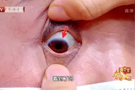 耳垂有褶，可能是“坏胆固醇”增多了！防心梗、降血脂，千万不能忽视这些图片