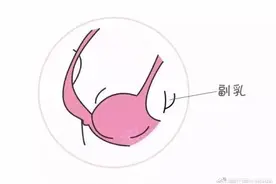塑形内衣可以治疗副乳？图片