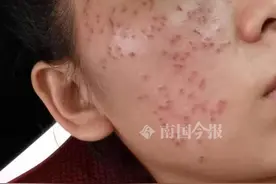 祛斑还是烂脸？柳州一女子去美容，结果太吓人图片