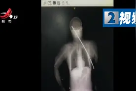 男子被钢筋刺穿身体插进颅内奇迹生还图片