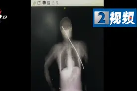 男子被钢筋刺穿身体插进颅内奇迹生还图片