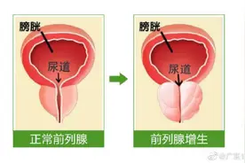 什么是前列腺增生？图片