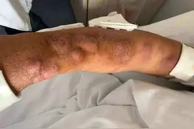 可怕！他手指扎进一个刺，没想到几天后，手臂冒出10多个瘤子图片