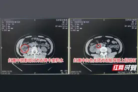 “麻将狂人”突发腰痛误认为久坐所致 检查发现结石危机图片