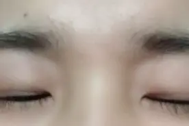 萧山一姑娘花一万多割双眼皮，晒前后对比照，引网友热议图片