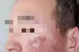 真冻脸！男子夜跑过后Ⅱ度冻伤，起水泡了图片