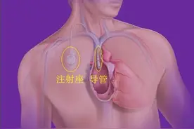 输液港：一种更“体贴”的输液方式图片