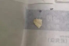 40岁的宁波船老大慌了，关节长满“石头”戳破膝盖，医生当场拔出3颗，他的习惯很多人都有图片