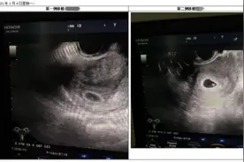 “好孕”来！南医大顺德医院首批“试管婴儿”移植成功图片