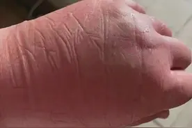 泪目！石家庄医护人员手被冻得像馒头图片