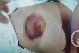 家长用热盐治疗拉肚子 四月大婴儿被烫伤图片
