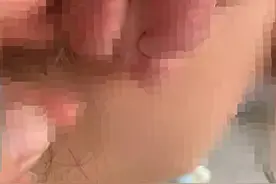 啊？！5年前街边小店打了个耳洞，衢州女子右耳长出一个大肉瘤图片